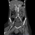 Computed Tomography Findings in Non-Obstetric Vulvar Hematoma: A Case Report 3 Vulvar Hematoma. CT Coronal Unannotated. JETem 2024