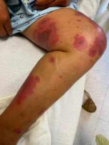 Erythema Multiforme. Medial leg. JETem 2025