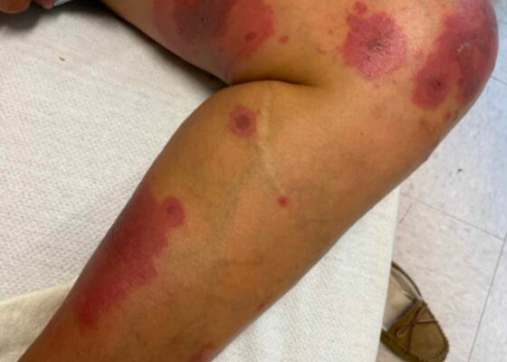 A Case Report on an Elusive Incident of Erythema Multiforme 16 Erythema Multiforme. Medial leg. JETem 2025