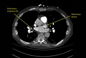 Wolff A et al. Right atrial thrombosis. CT axial PE 2