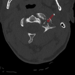 A Case Report of an Unstable C-spine Fracture in the Emergency Department 4 CSpine Fracture CT Axial Annotated. JETem 2025