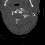 A Case Report of an Unstable C-spine Fracture in the Emergency Department 1 CSpine Fracture CT Axial Unannotated. JETem 2025