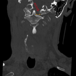 A Case Report of an Unstable C-spine Fracture in the Emergency Department 5 CSpine Fracture CT Coronal Annotated. JETem 2025