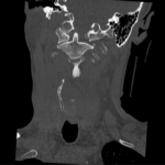 A Case Report of an Unstable C-spine Fracture in the Emergency Department 2 CSpine Fracture CT Coronal Unannotated. JETem 2025