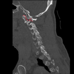 A Case Report of an Unstable C-spine Fracture in the Emergency Department 6 CSpine Fracture CT Sagital Annotated. JETem 2025