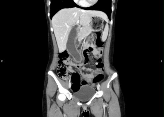 A Case Report of Hydropic Gallbladder Presenting as Right Lower Quadrant Abdominal Pain 4 Hydropic Gallbladder. CT Coronal Unannotatd. JETem 2025
