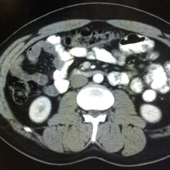 Case Report: Iatrogenic Bowel Perforation Following Dental Procedure 9 Iatrogenic Bowel Perforation Following Dental Procedure. CT. Unannotated. JETem 2025