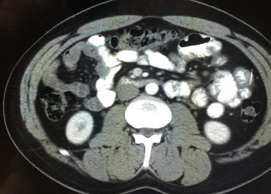 Case Report: Iatrogenic Bowel Perforation Following Dental Procedure 12 Iatrogenic Bowel Perforation Following Dental Procedure. CT. Unannotated. JETem 2025