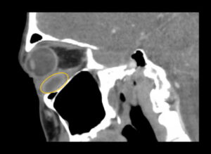 Inferior Rectus Abscess CT Sagital Annotated. JETem 2025