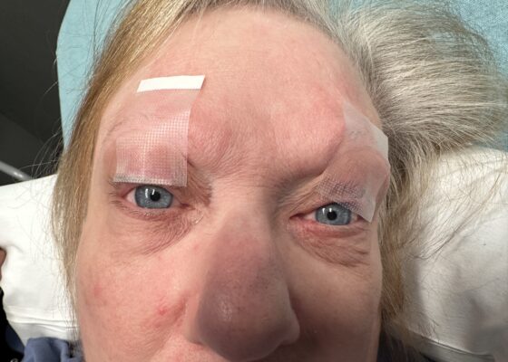 Myasthenia Gravis Eyes Taped Open. JETem 2025