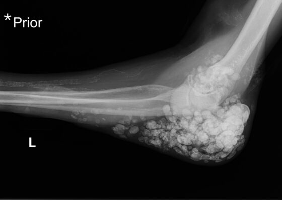 Metastatic Calcinosis Cutis in the Emergency Department: A Case Report 4 Calcinosis Cutis. Prior Elbow XR Lateral. JETem 2025