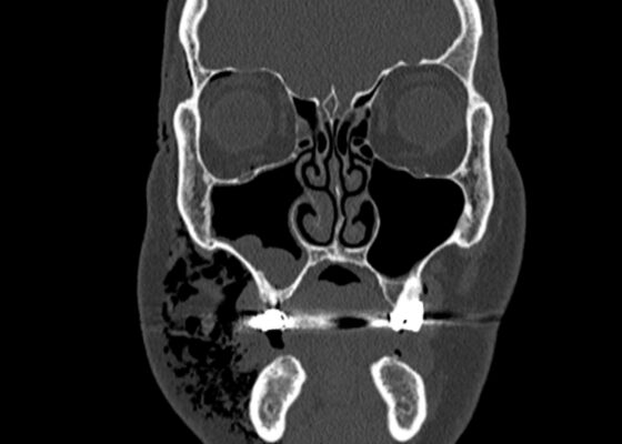 Dental Free Air CT Coronal Unannotated. JETem 2025