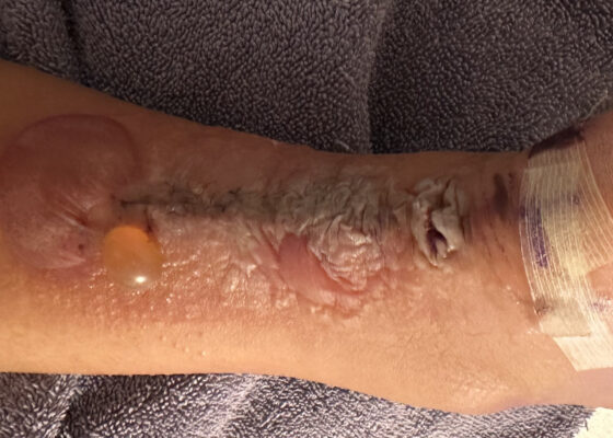 Case Report of a Dermatologic Reaction to Wound Closure Strips and Liquid Adhesive 10 Dermatologic Reaction to Wound Closure Strips and Liquid Adhesive. Photo 3 Unannotated. JETem 2025