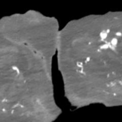 A Case Report of an Atypical Presentation of Fournier’s Gangrene 2 Atypical Presentation of Fourniers Gangrene. CT. JETem 2026