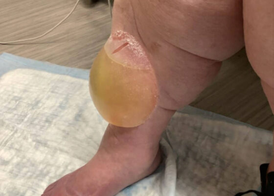 Effects of Volume Overload: A Case Report of an Edema Bulla 8 Edema Bulla. Photo 1. JETem 2026