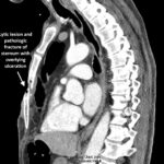Open Chest Wound with Sternal Fracture in the Emergency Department, a Case Report 4 Open Chest Wound. CT annotated. JETem 2026