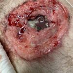 Open Chest Wound with Sternal Fracture in the Emergency Department, a Case Report 3 Open Chest Wound. Photo. JETem 2026