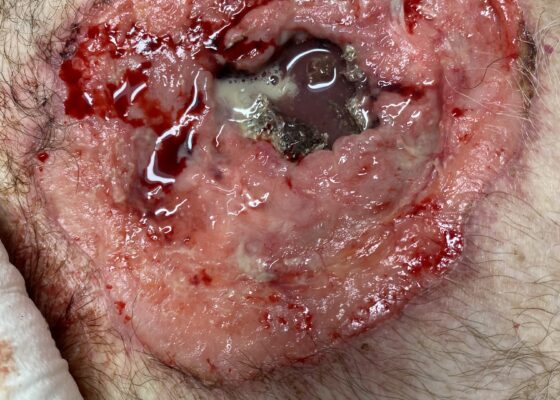 Open Chest Wound with Sternal Fracture in the Emergency Department, a Case Report 6 Open Chest Wound. Photo. JETem 2026