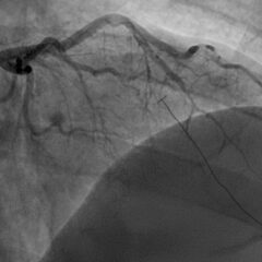 SCAD. Angiography. JETem 2026