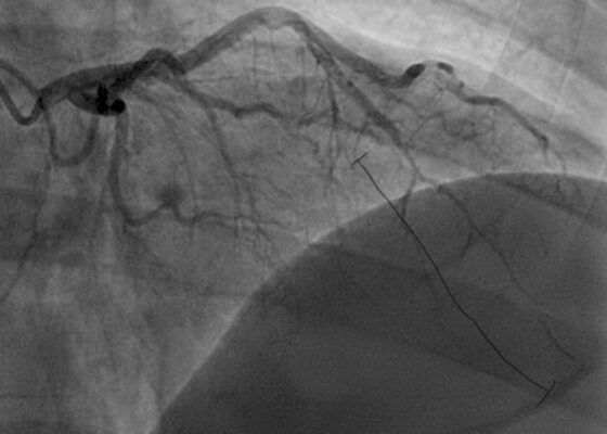A Case Report of a 36-year-old Male Diagnosed with a Spontaneous Coronary Artery Dissection 2 SCAD. Angiography. JETem 2026