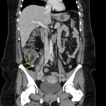 A Case Report of Acute Appendicitis Complicated by Appendicoliths 2 Appendicolith. CT Annotated 2. JETem 2026