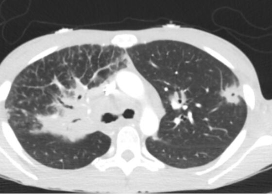 Case Report: Acute Dyspnea in a Young Female 4 Sarcoidosis CT. Lung View. JETem 2026