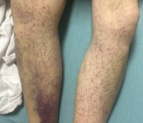 Overlooked and Undernourished: A Case Report of Scurvy Linked to Food Insecurity 2 Scurvy Linked to Food Insecurity. Photo B. Unannotated. JETem 2026