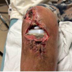 Visual Case Report of a Prosthetic Joint Infection and Chronic Dehiscence following a Total Knee Arthroplasty 2 Prosthetic Joint Infection Open Knee Photo AP. JETem 2026