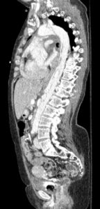 Rapidly Progressive Painless Acute Aortic Dissection. CT Sagittal. JETem 2026