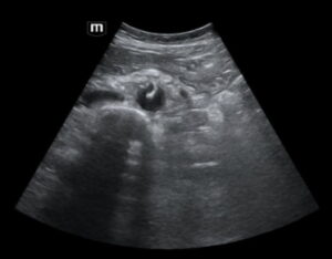 Rapidly Progressive Painless Acute Aortic Dissection. US Dissection 2. JETem 2026