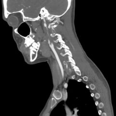 Blunt Cerebrovascular Injury. CT Sagital Internal Carotid Unannotated. JETem 2026