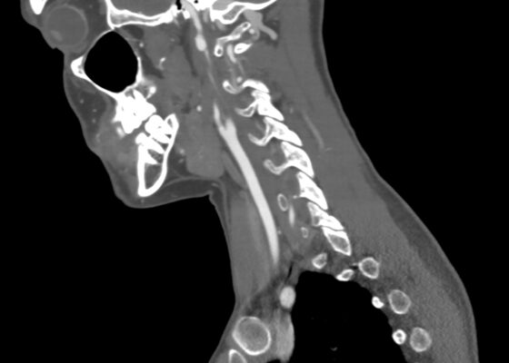 Blunt Cerebrovascular Injury: A Visual Case Report with Computed Tomography Angiography Findings Revealing Carotid and Vertebral Artery Dissection 14 Blunt Cerebrovascular Injury. CT Sagital Internal Carotid Unannotated. JETem 2026
