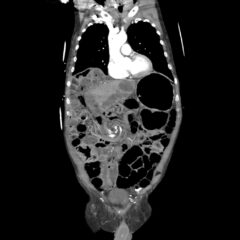 Caught in the Whirl: A Case Report of Midgut Volvulus in an Elderly Patient 5 Caught in the Whirl. CTA Coronal 1 Unannotated. JETem 2026