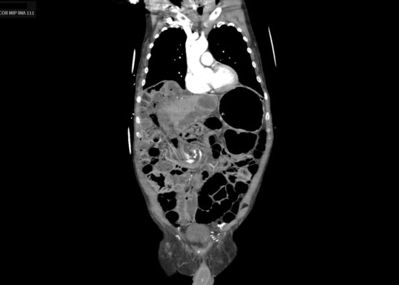 Caught in the Whirl: A Case Report of Midgut Volvulus in an Elderly Patient 20 Caught in the Whirl. CTA Coronal 1 Unannotated. JETem 2026