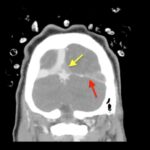Cerebral Venous Thrombosis. CT Coronal Annotated. JETem 2026