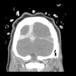 Cerebral Venous Thrombosis. CT Coronal Unannotated. JETem 2026