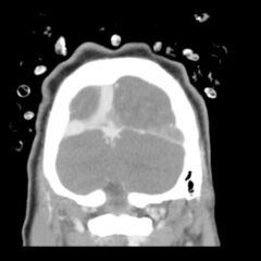 Cerebral Venous Thrombosis. CT Coronal Unannotated. JETem 2026