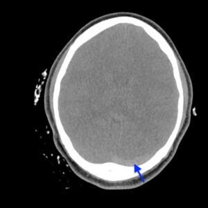 Cerebral Venous Thrombosis. CT Non Contrast Axial Annotated. JETem 2026