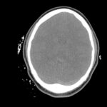 Cerebral Venous Thrombosis. CT Non Contrast Axial Unannotated. JETem 2026