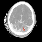 Cerebral Venous Thrombosis. CTA Axial Annotated. JETem 2026