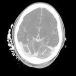 Cerebral Venous Thrombosis. CTA Axial Unannotated. JETem 2026