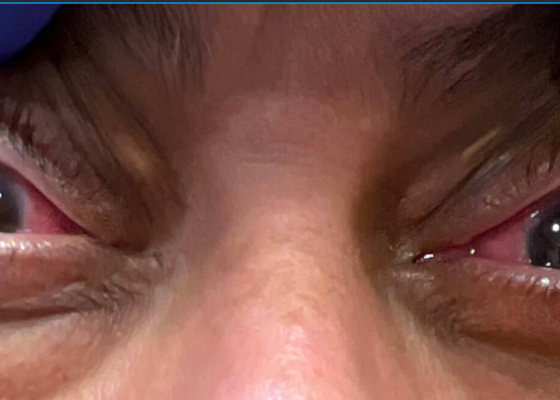A Case Report of Granulomatosis with Polyangiitis Presenting with Chronic Conjunctivitis 18 Granulomatosis with Polyangiitis. Chonic Conjunctivitis. JETem 2026
