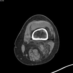 Hematoma Hemarthrosis and Hemotympanum. CT Knee Distal Femur. JETem 2026