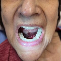 Hematoma Hemarthrosis and Hemotympanum. Sublingual Hematoma. JETem 2026