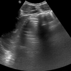 Occult Pneumoperitoneum. Figure 1 Unannotated. JETem 2026