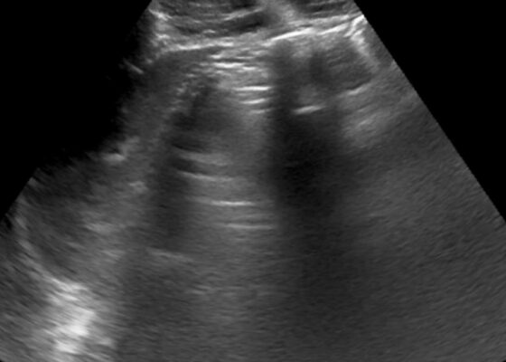 A-Lines below the Diaphragm – A Case Report of Occult Pneumoperitoneum 16 Occult Pneumoperitoneum. Figure 1 Unannotated. JETem 2026